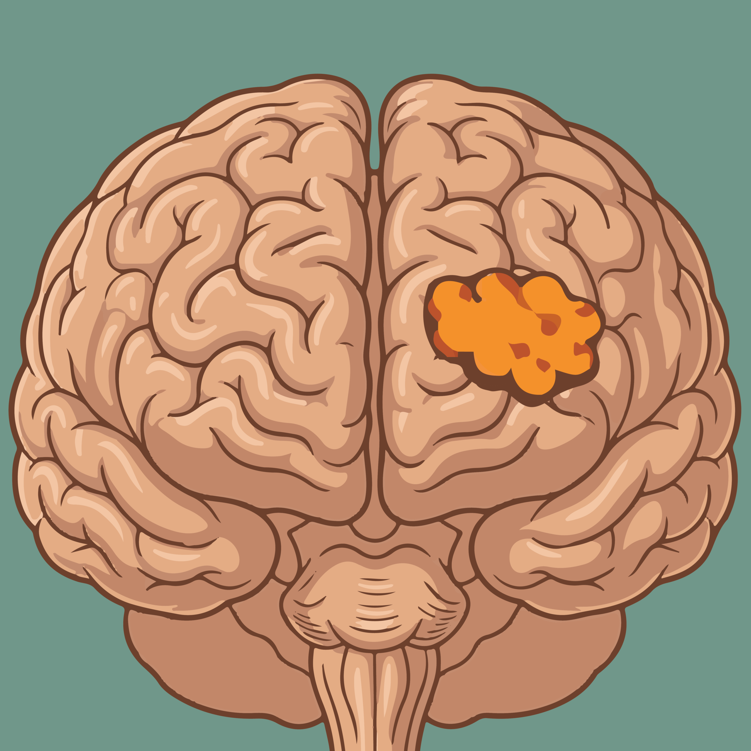 Brain tumour